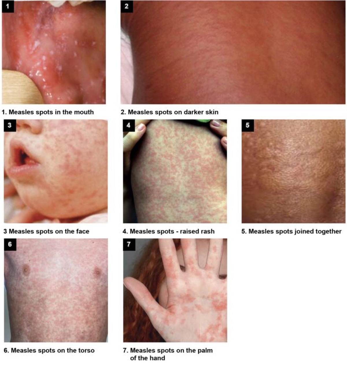 measles images